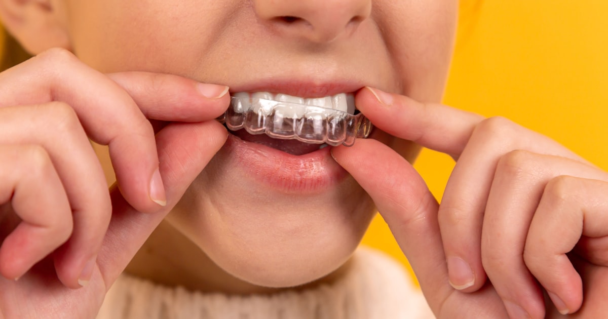 Carbamide Peroxide Teeth Whitening: the Professional's Guide to Getting It Right