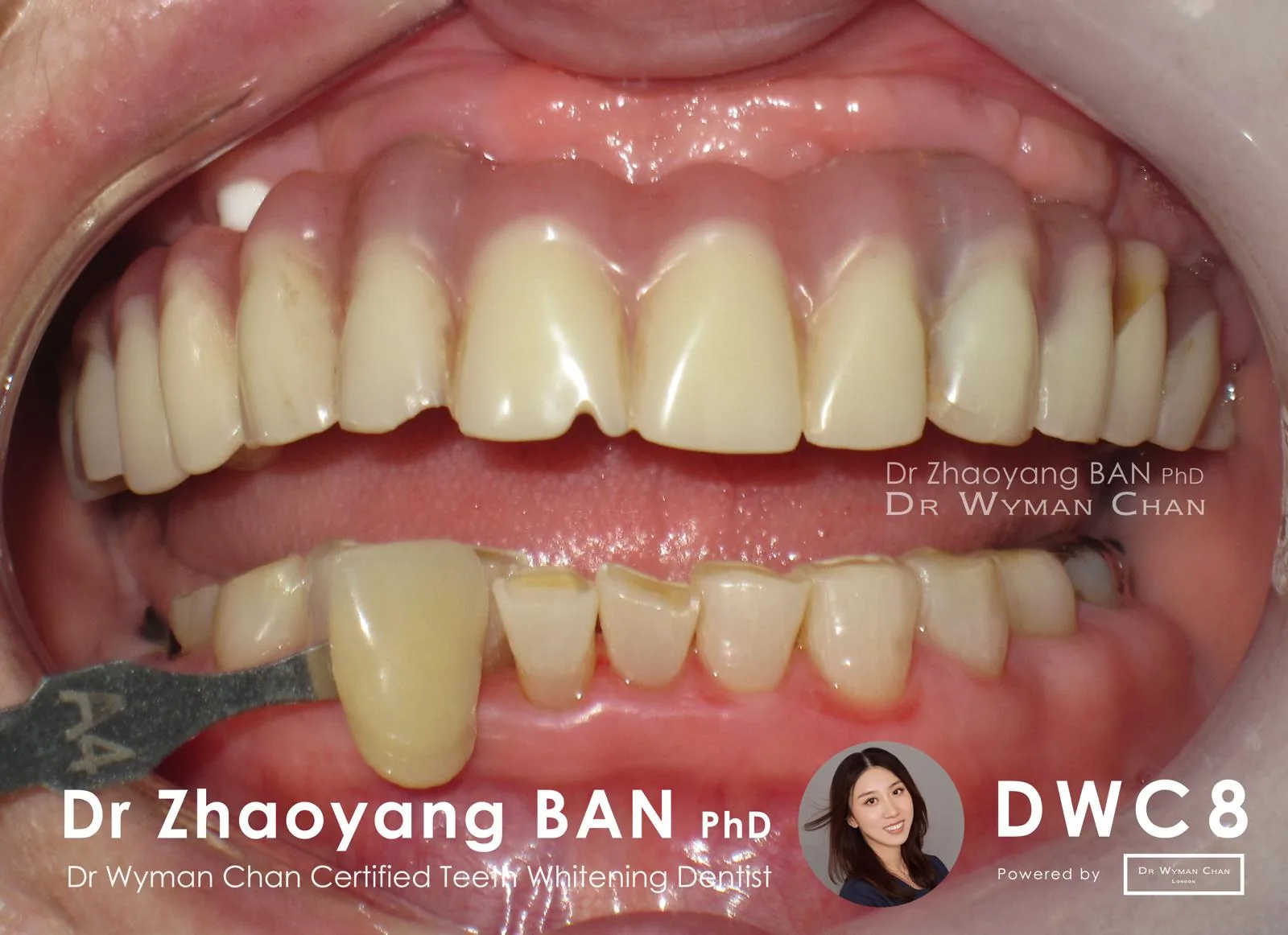 DWC8 case, after a two-week course: visibly lighter shade with the patient comfortable throughout.