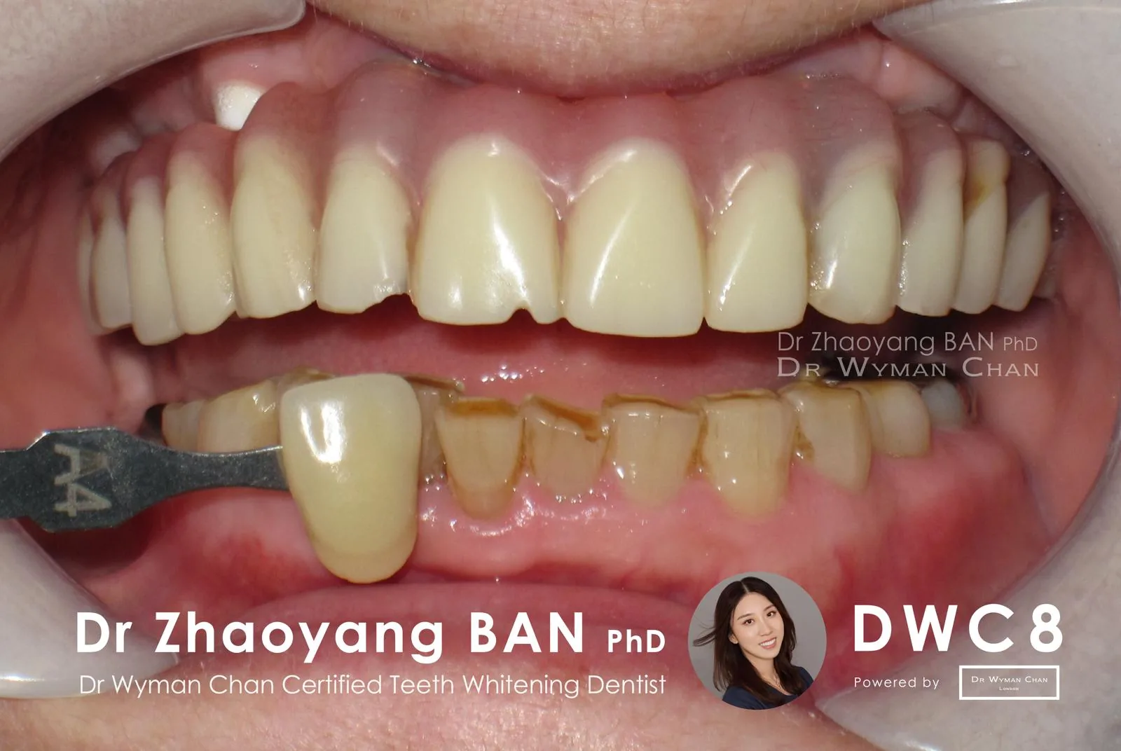 DWC8 case, before: baseline shade on a sensitivity-prone patient.
