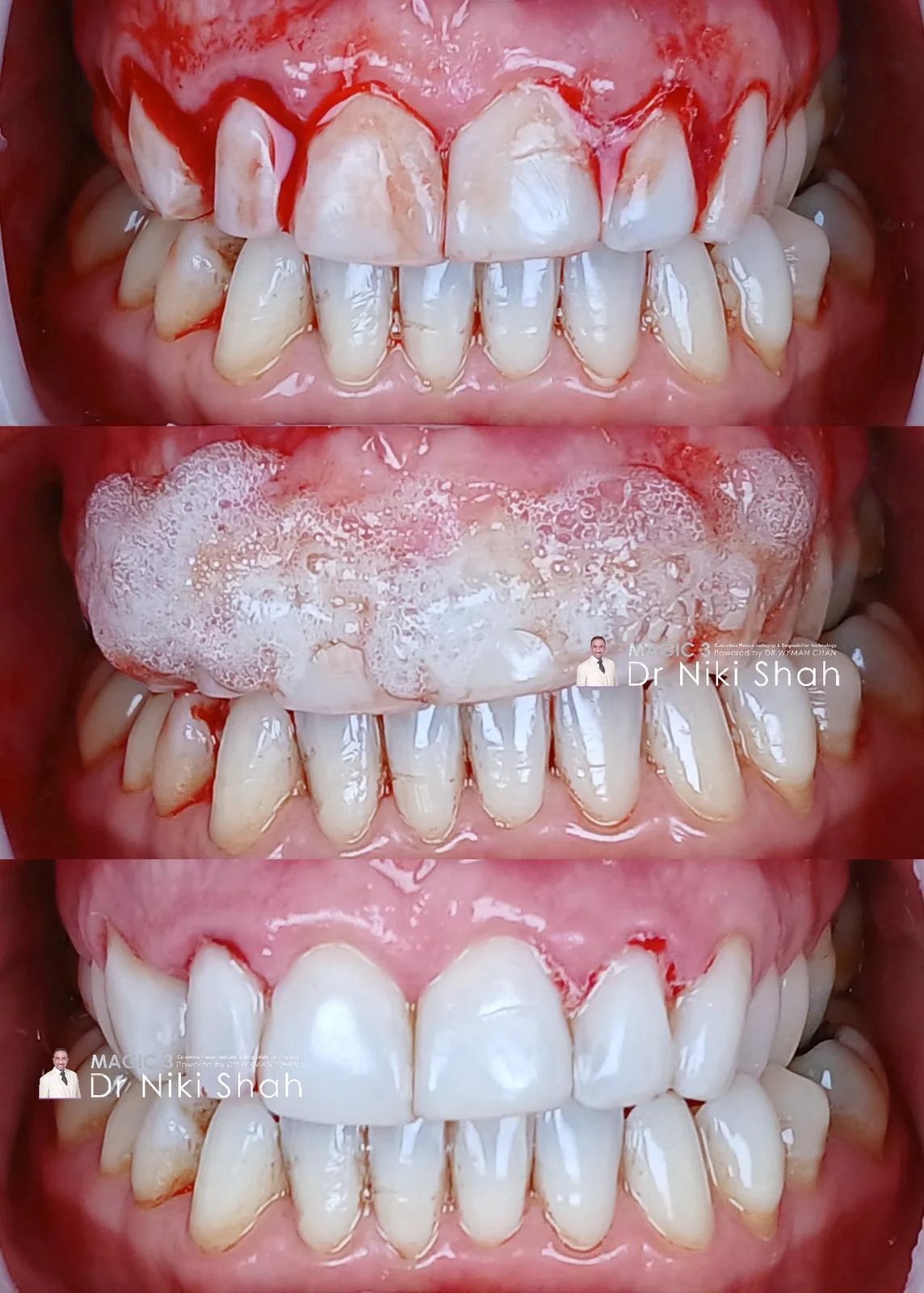 Magic 3 clinical case by Dr Niki Shah: before, during and after applying Magic 3 foam to bleeding gingivitis. Bleeding resolves and gums visibly calm.